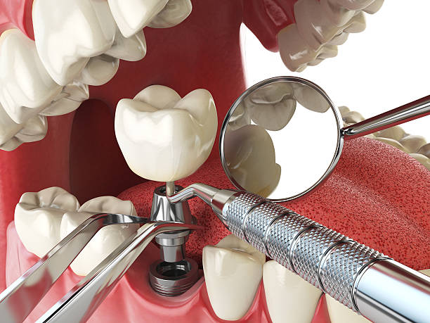 Best Emergency Dentist for Lost Fillings or Crowns in Lakeside, TX